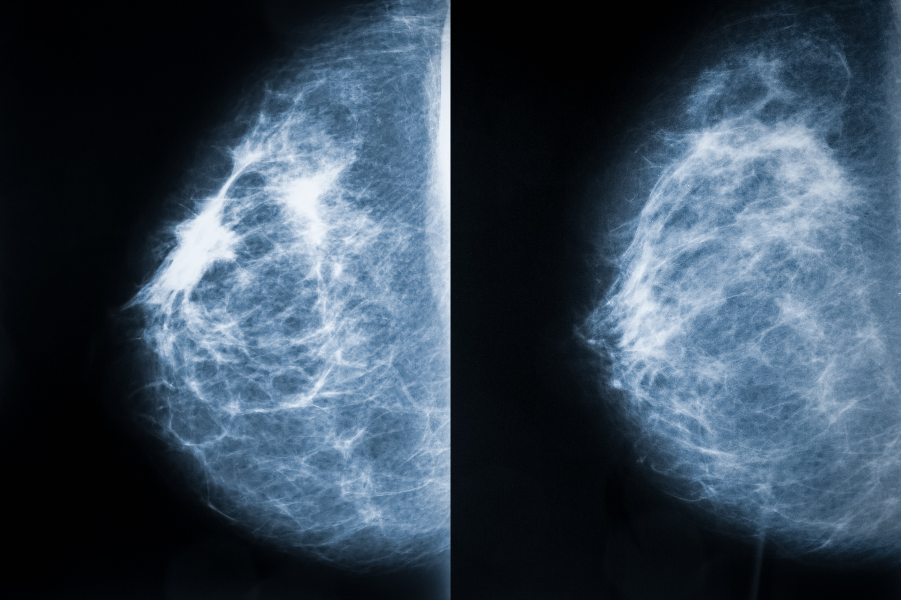 Mammogram X-rays showing breast tissue analysis