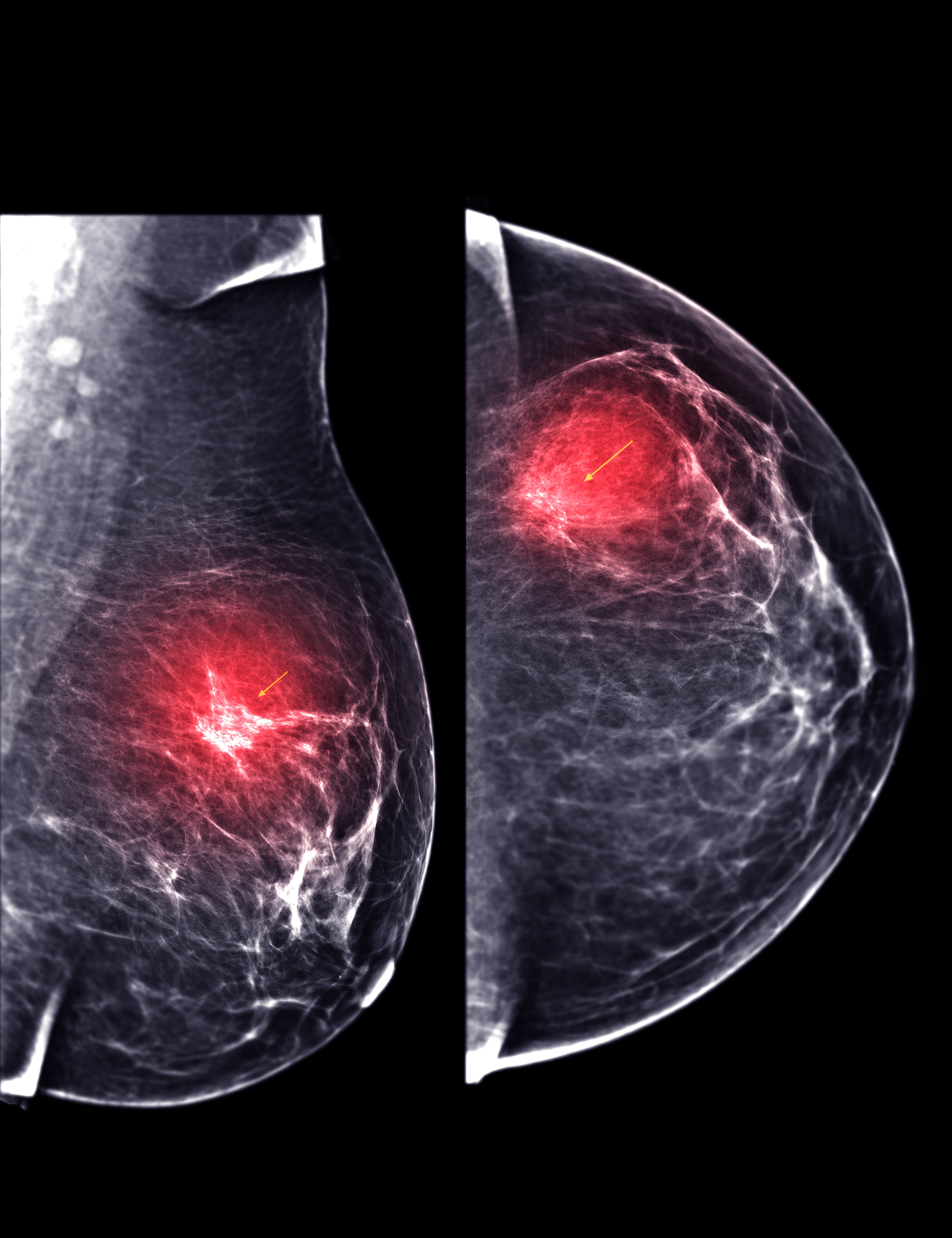 Mammogram highlighting areas of concern in breast tissue